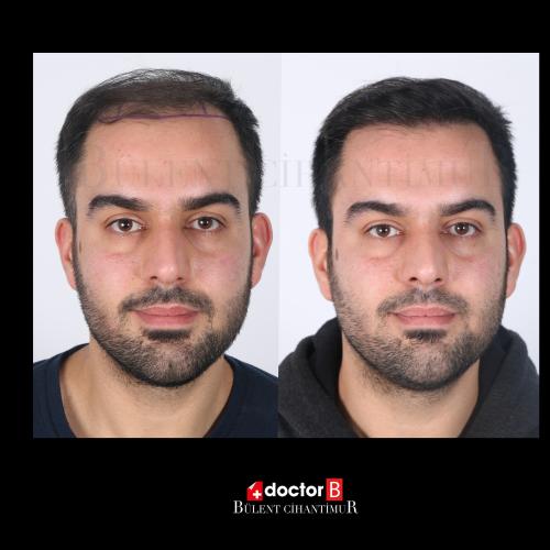 Organic hair transplantation Before / After photo